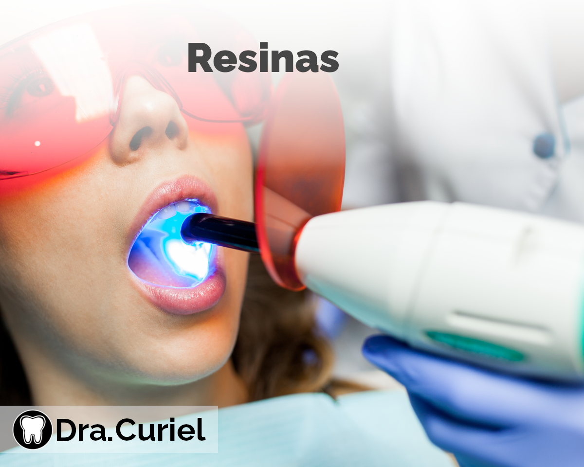 Resinas Dentales | Doctora Curiel